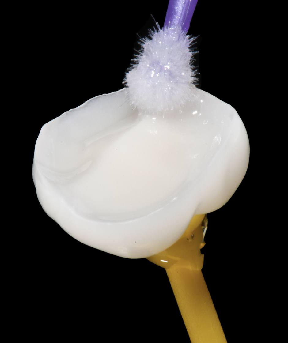 Teilkrone vor dem Zementieren. Close-Up