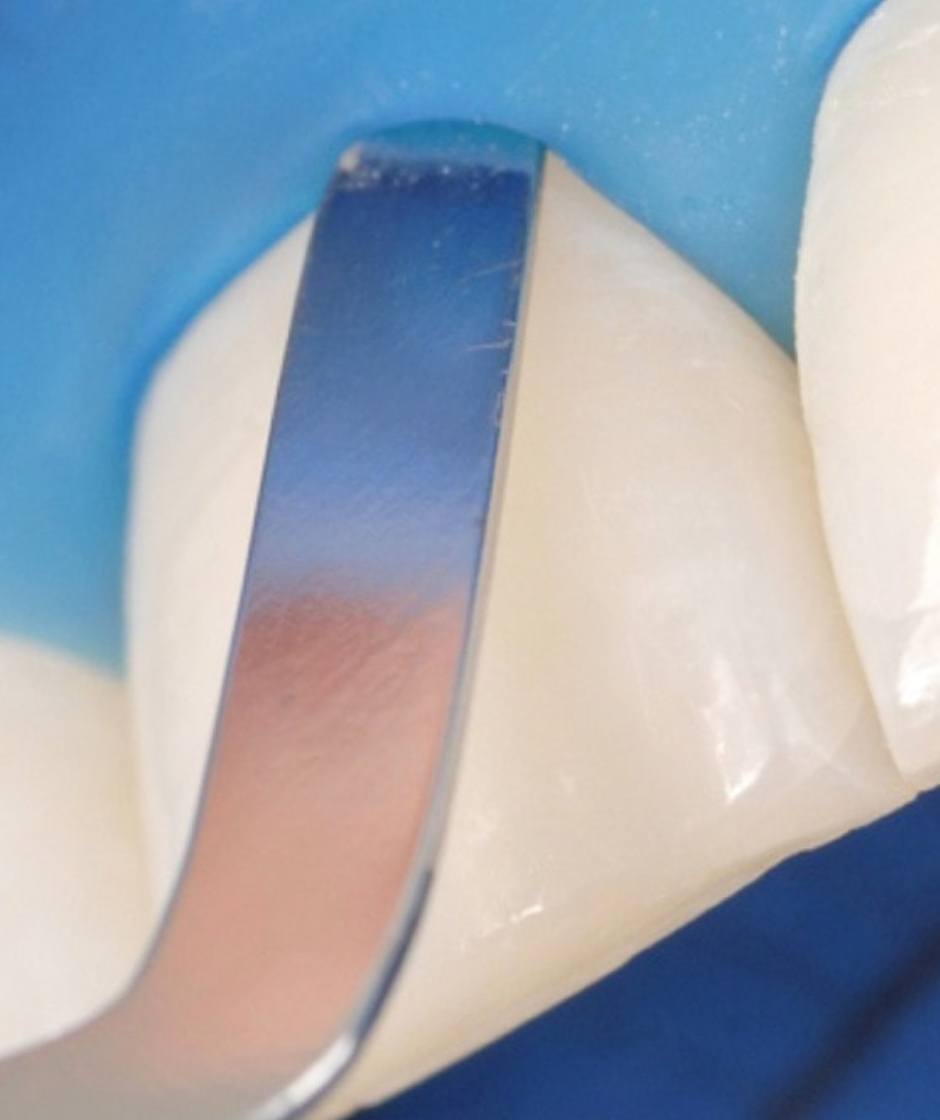 Frontzahnisolation mit OptraDam, dem dreidimensionalen Kofferdam