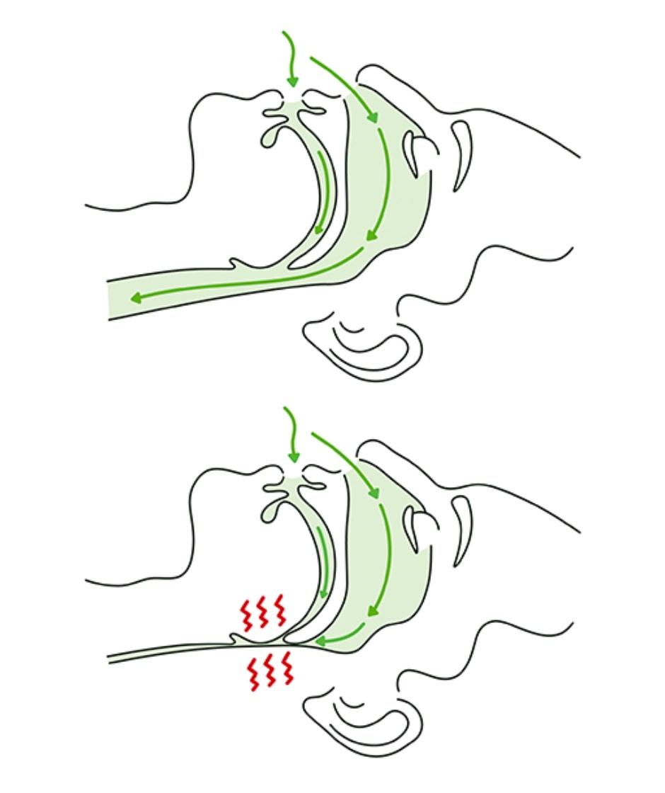 Abbildung auf der gezeigt wird wie der Kiefer beim Schlafen nach unten Kippt und somit eine Schlafapnoe gefördert wird.