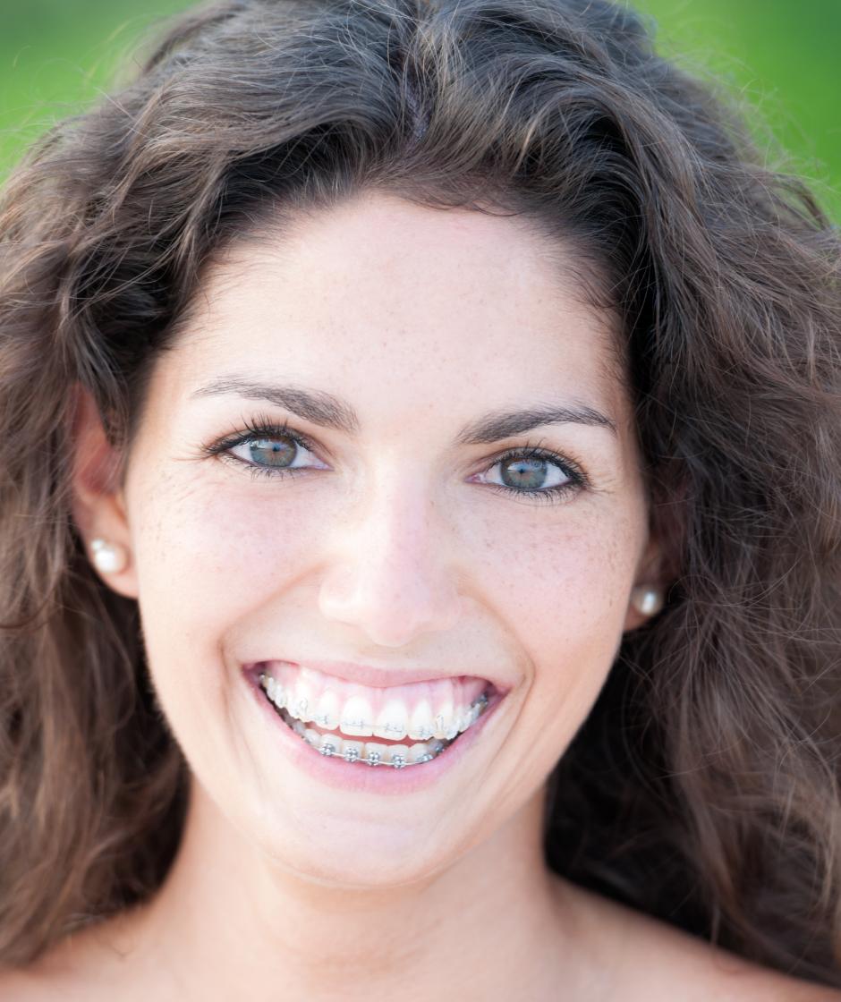 Portrait einer Frau mit einer festen Zahnspange von aussen.