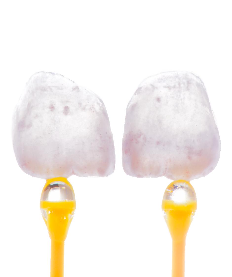 Zwei individuelle Veneers aus Keramik fotografiert vor weißem Hintergrund an gelben Klebesticks