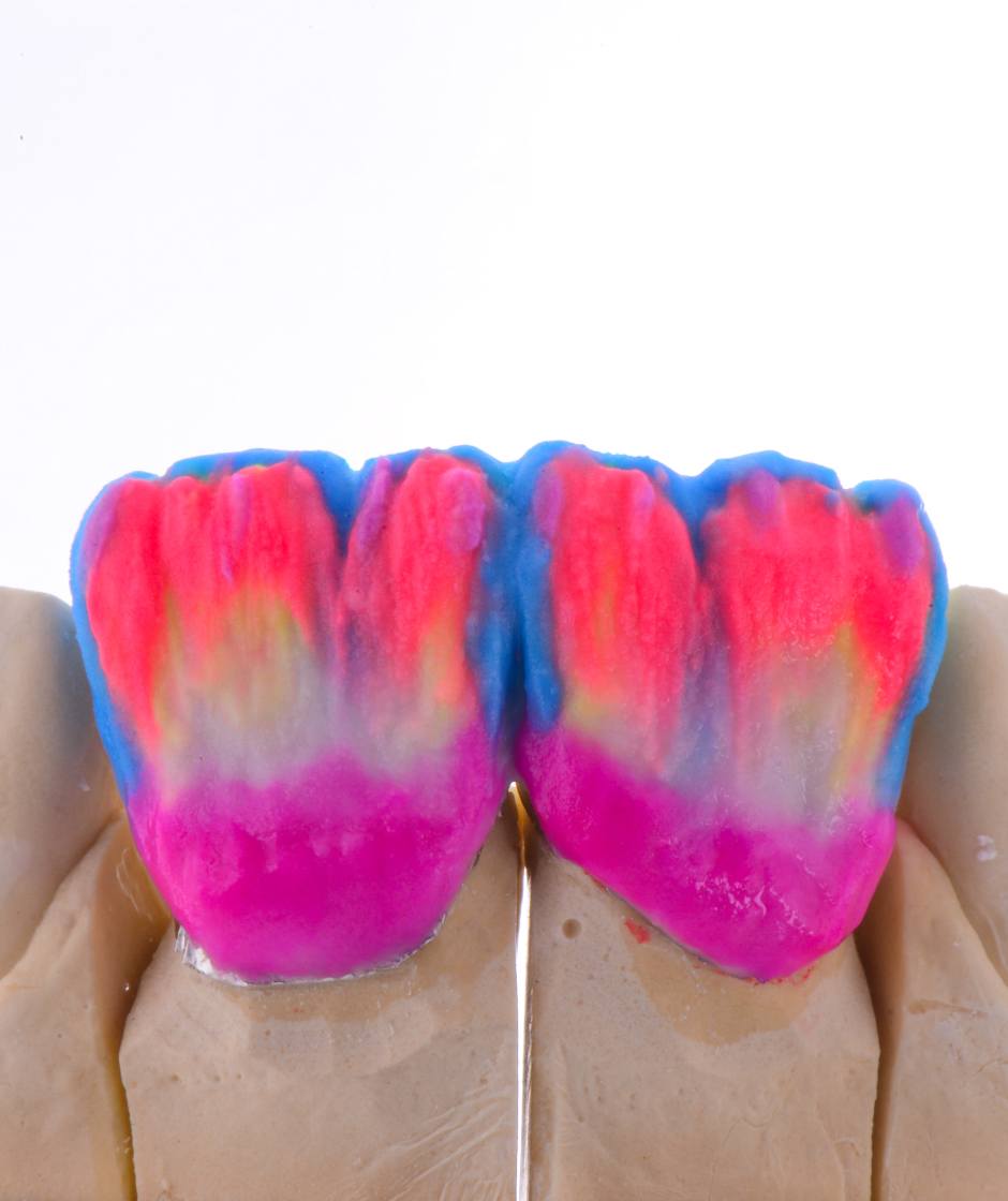 Schichtung eines individuellen Keramik-Veneers mit farbigen Keramikpudern.