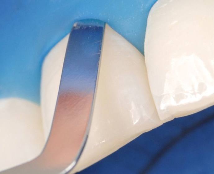 Optradam, der moderne Kofferdam