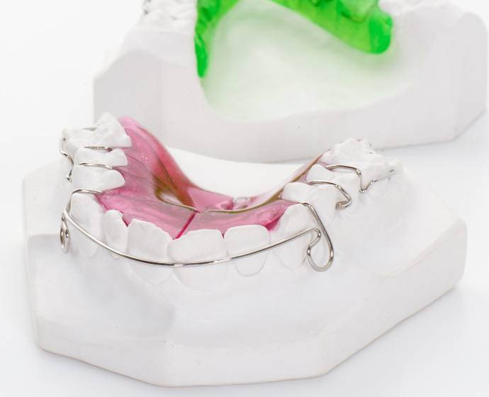 Herausnehmbare Zahnspange an einem Gipsmodell.