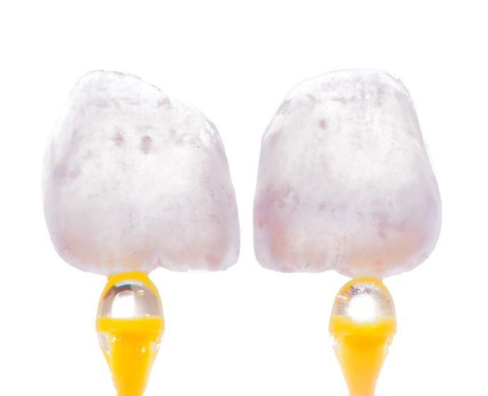 Zwei individuelle Veneers aus Keramik fotografiert vor weißem Hintergrund an gelben Klebesticks