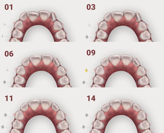 Schematischer Ablauf einer Invisalign Behandlung. Die Zähne werden über kleine Zwischenschritte durch die unsichtbare Zahnspange in die richtige Position gebracht