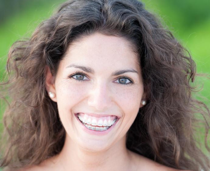 Portrait einer Frau mit einer festen Zahnspange von aussen.