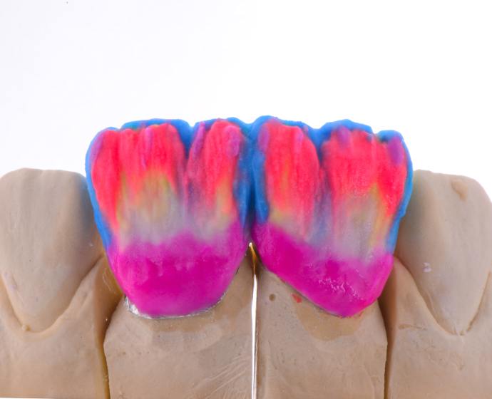 Schichtung eines individuellen Keramik-Veneers mit farbigen Keramikpudern.