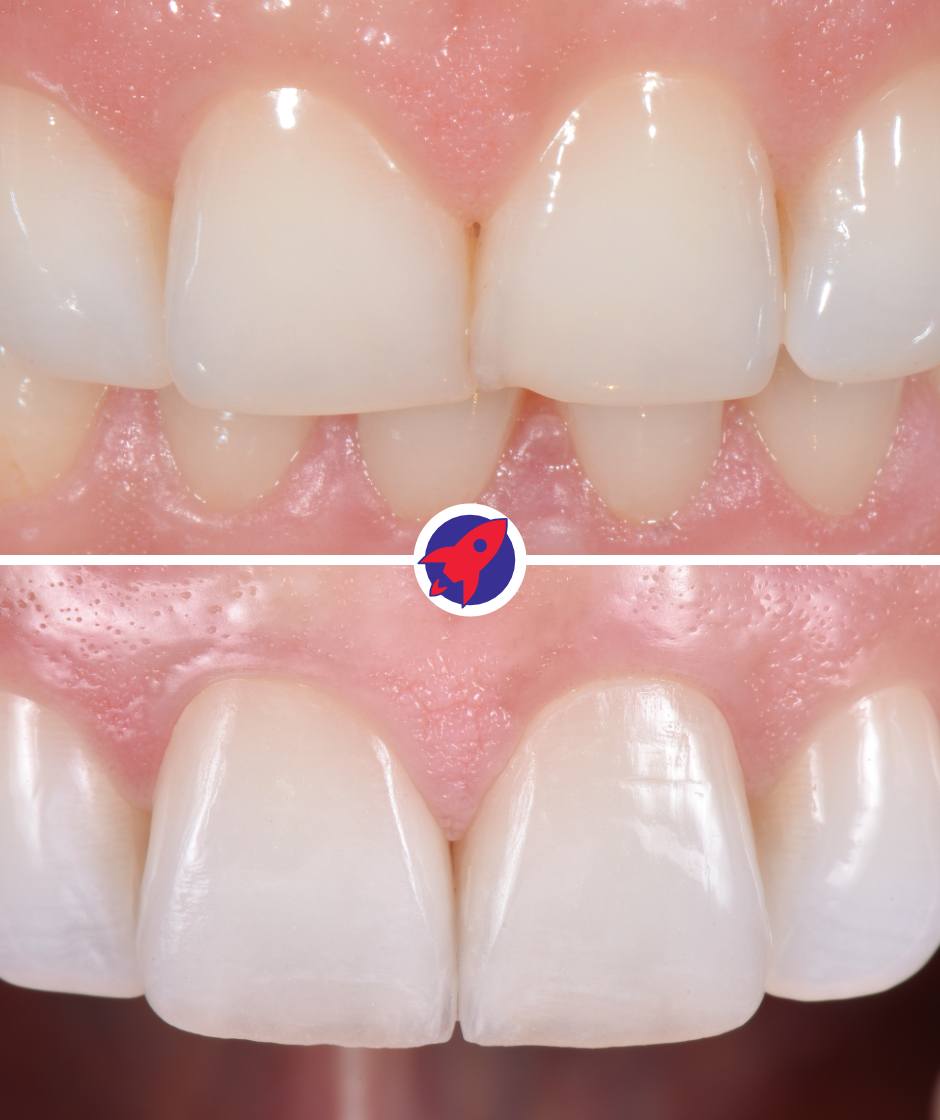 Vorher-nachher Bilder einer Behandlung mit 2 Veneers um abgenutzte Zähne zu verlängern.