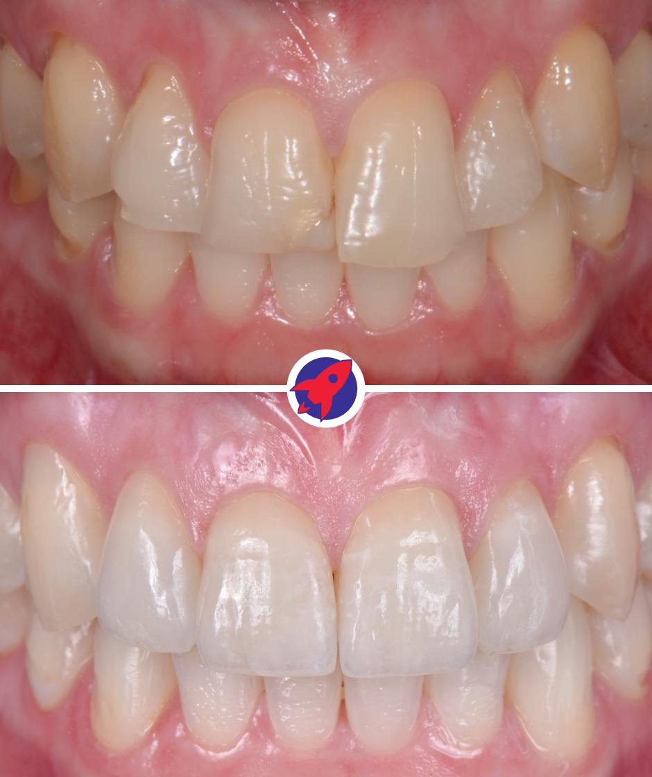 Vorher-nachher Bilder einer Behandlung mit 4 Veneers aus Keramik.