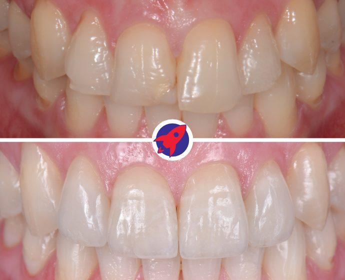 Vorher-nachher Bilder einer Behandlung mit 4 Veneers aus Keramik.