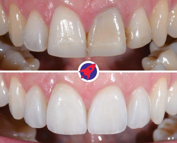 Vorher-nachher Bilder einer Behandlung mit 4 Veneers, um einen durch eine Wurzelkanalbehandlung dunklen Zahn abzudecken.