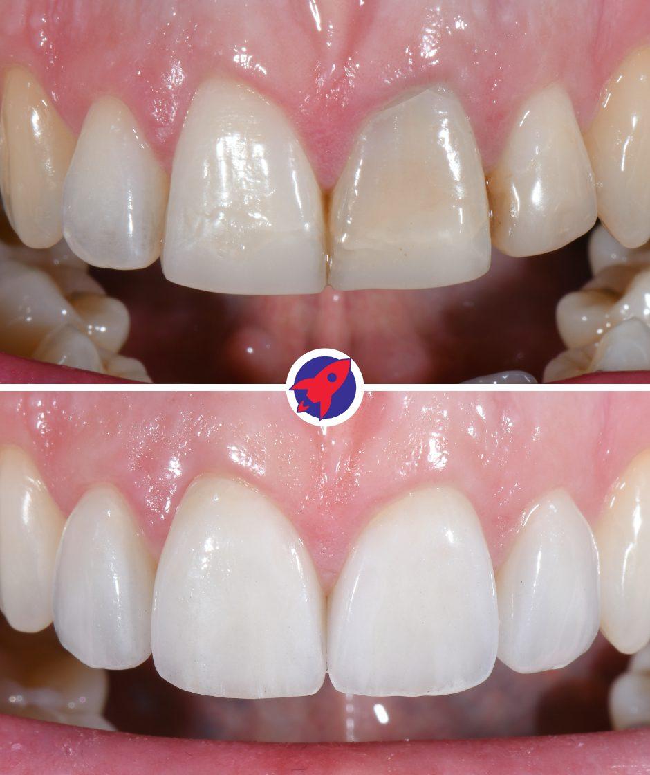 Vorher-nachher Bilder einer Behandlung mit 4 Veneers, um einen durch eine Wurzelkanalbehandlung dunklen Zahn abzudecken.