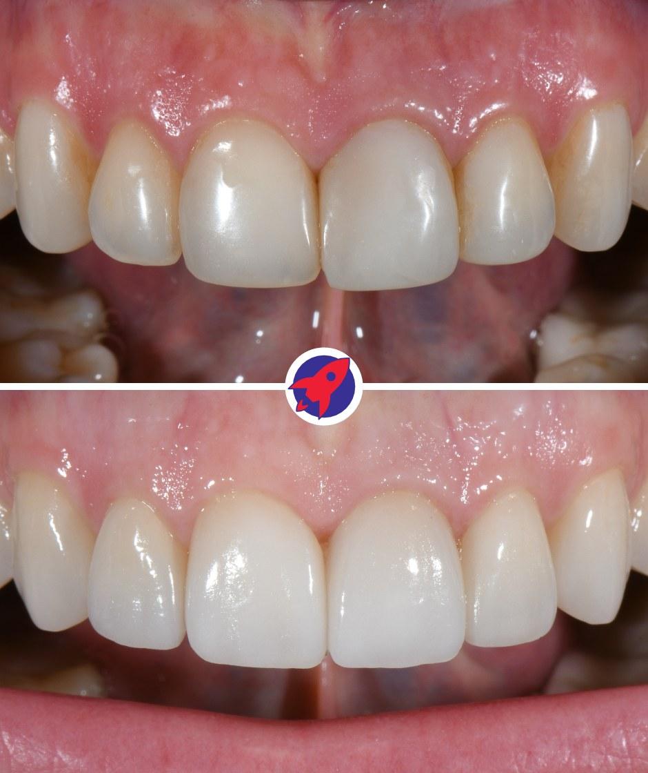 Vorher-nachher Bilder einer ästhetischen Behandlung mit 6 Veneers.