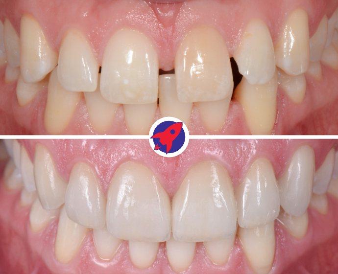 Vorher-nachher Bilder einer Behandlung mit 6 Veneers um Zahnlücken zu schließen.