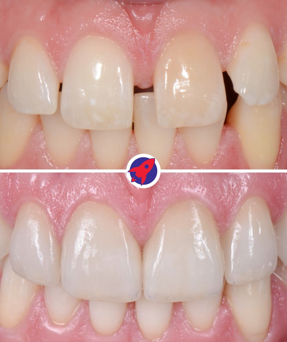 vorher-nachher Bilder einer Behandlung mit 6 Veneers um Zahnlücken zu schließen