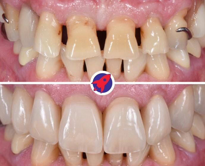 Vorher-nachher Bilder einer Zahnsanierung bei der eine Zahnprothese durch feste Zähne auf Implantaten ersetzt wurde.
