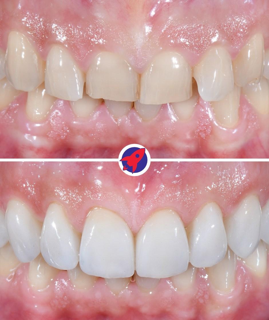 Vorher-nachher Bilder einer Patientin die sich ein Hollywood-Smile wünschte. Wir konnten das Ziel mit 16 Veneers erreichen.