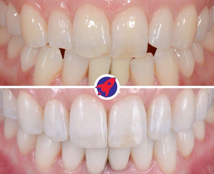 Vorher-nachher Bilder einer Invisalign Behandlung bei der schiefe Zähne begradigt wurden.