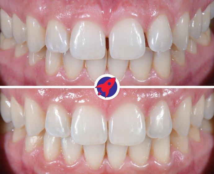 Vorher-nachher Bilder einer Invisalign Behandlung um Zahnlücken zu schließen.