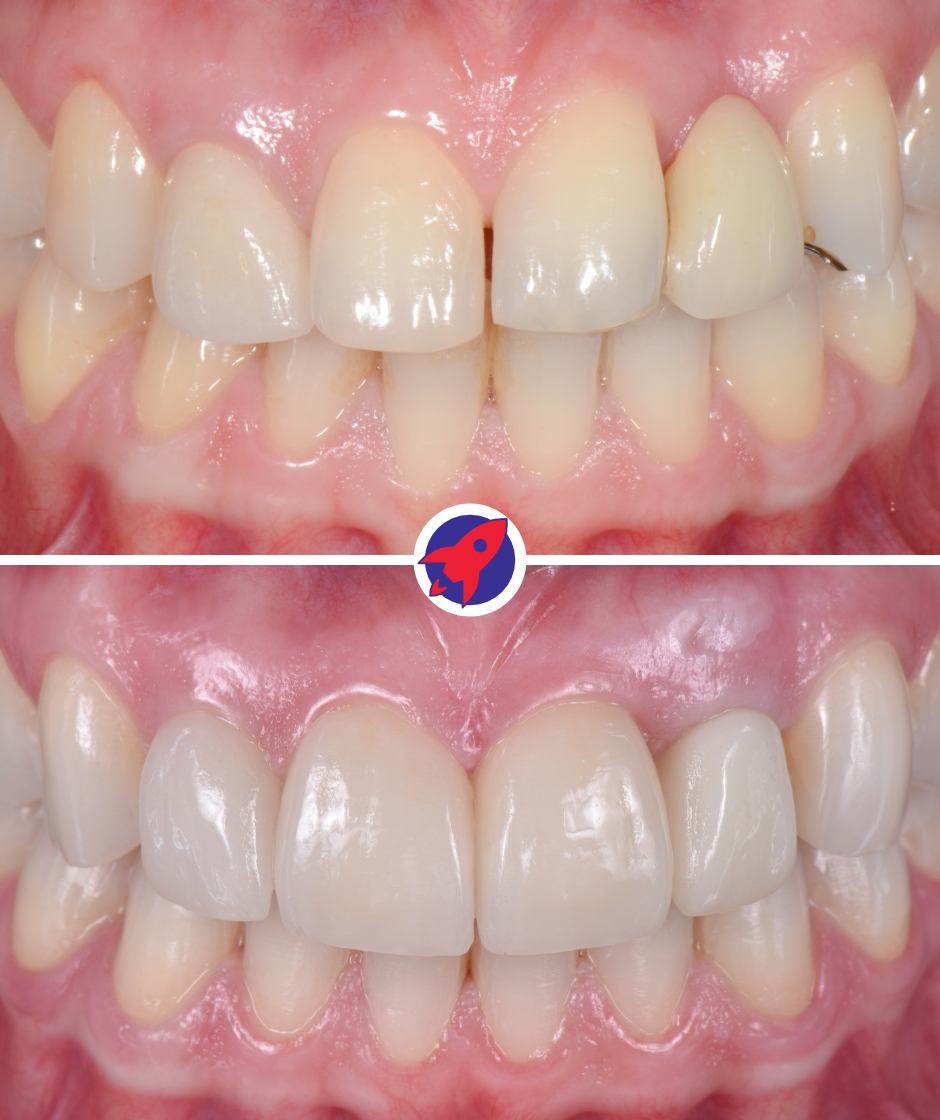 Vorher-nachher Bilder einer komplexen Behandlung mit Veneers und Zahnspange.