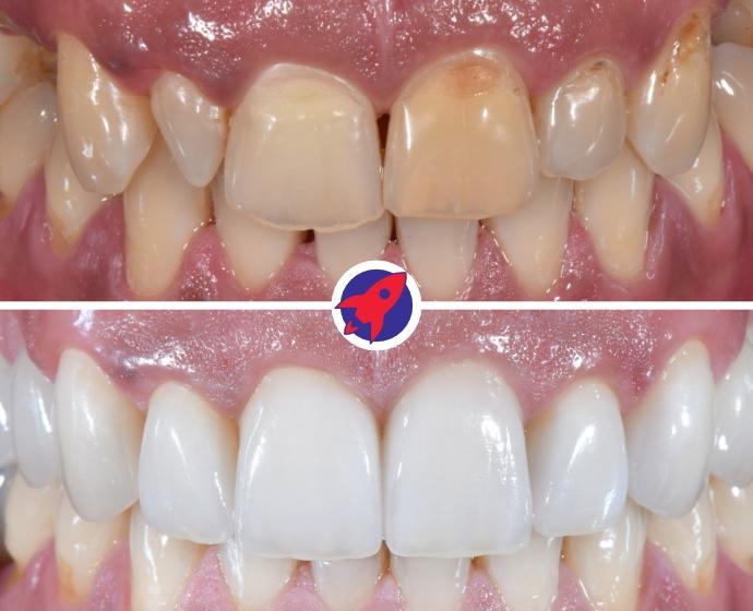 vorher-nachher Bilder einer kompletten Zahnsanierung mit Zahnkronen und Implantaten