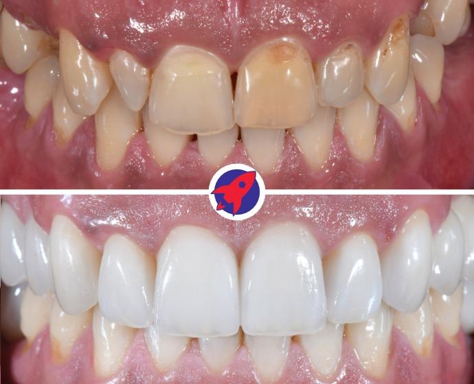 vorher-nachher Bilder einer kompletten Zahnsanierung mit Zahnkronen und Implantaten