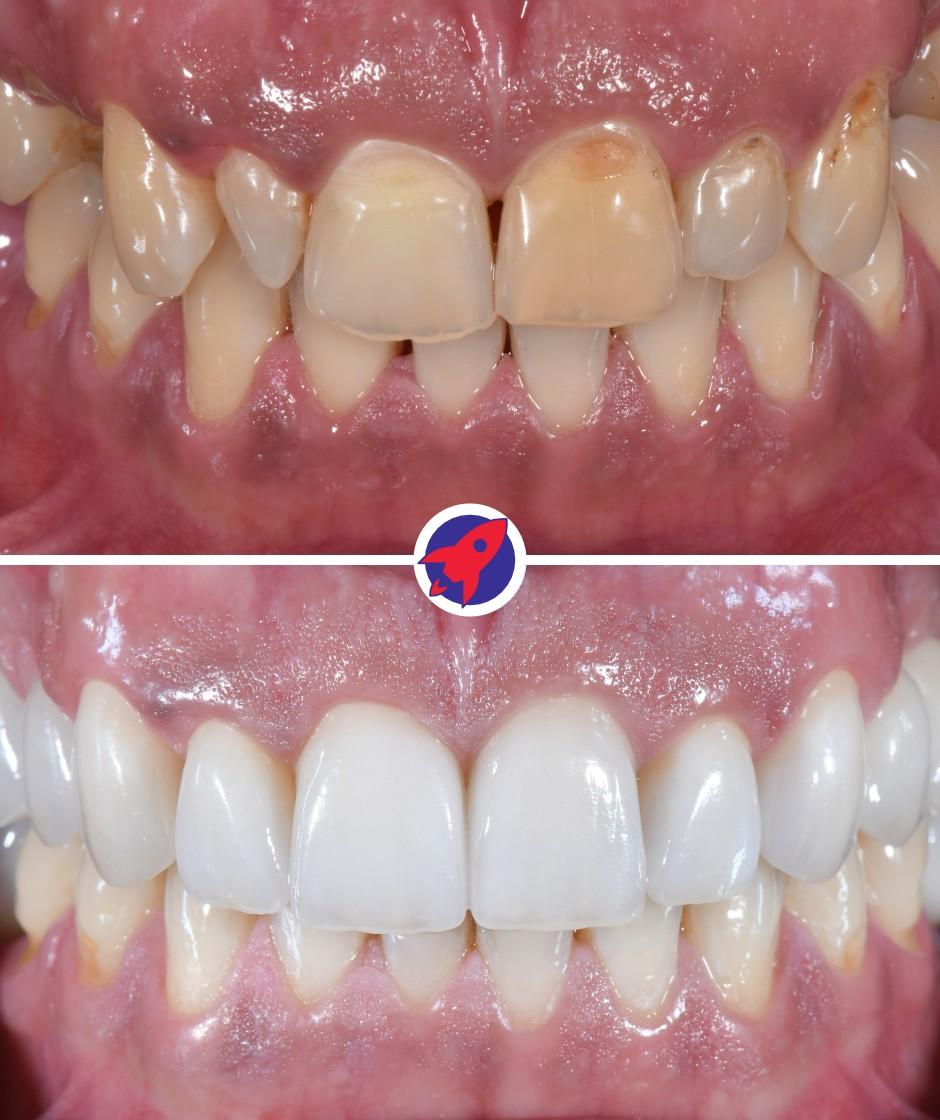 vorher-nachher Bilder einer kompletten Zahnsanierung mit Zahnkronen und Implantaten