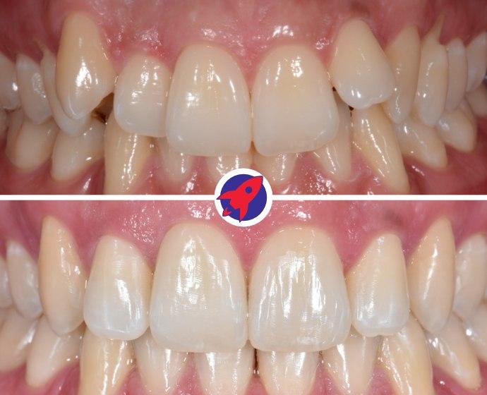 Vorher-nachher Bild einer Behandlung mit einer festen Zahnspange für ein schönes Lächeln.