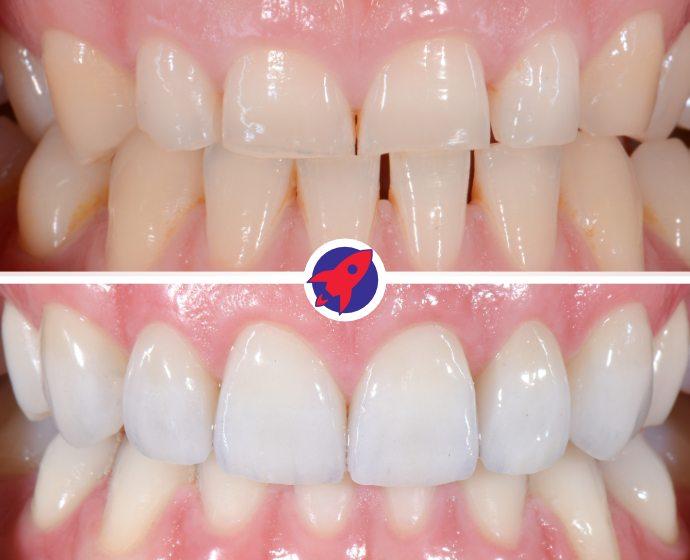 Vorher-nachher Bild eines ästhetischen Falls in dem abgenutzte Zähne verlängert wurden.