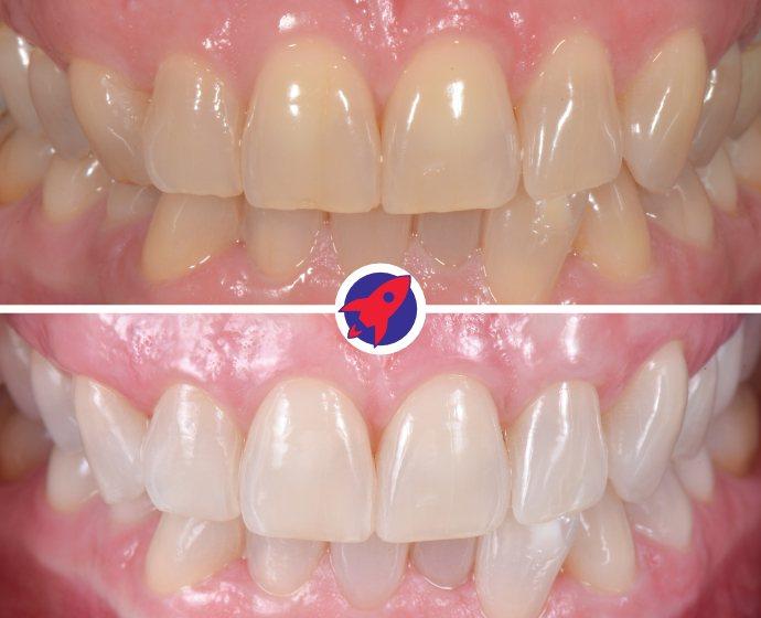 Vorher-nachher Bild einer Zahnaufhellung mit Bleaching.