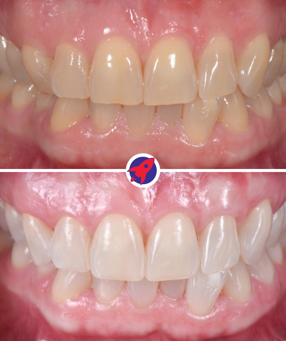 Vorher-nachher Bild einer Zahnaufhellung mit Bleaching.