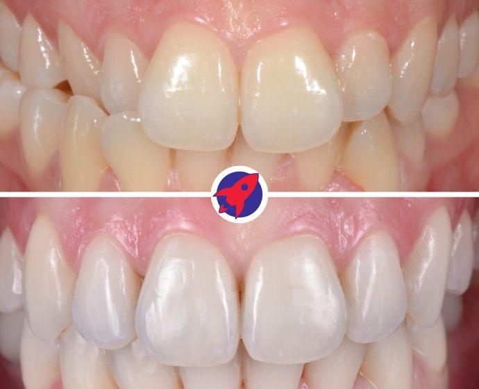 Vorher-nachher Bild schöner Zähne nach einem Bleaching und einer Zahnkorrektur.