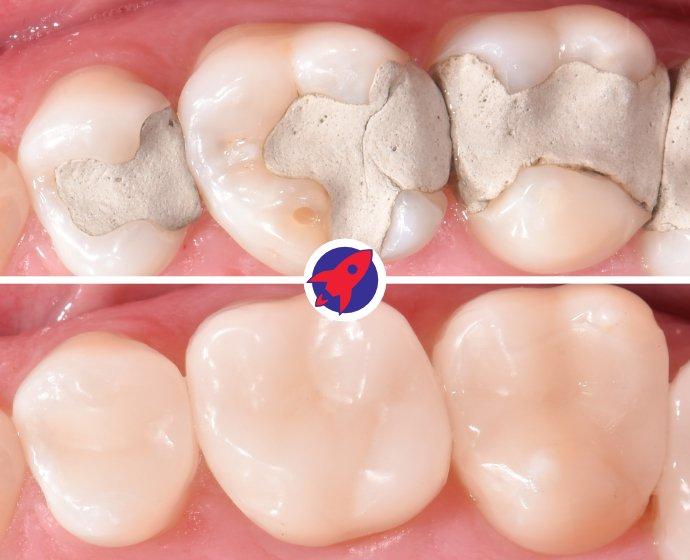 Vorher-nachher Bild einer CEREC-Behandlung mit Inlays und Onlays.