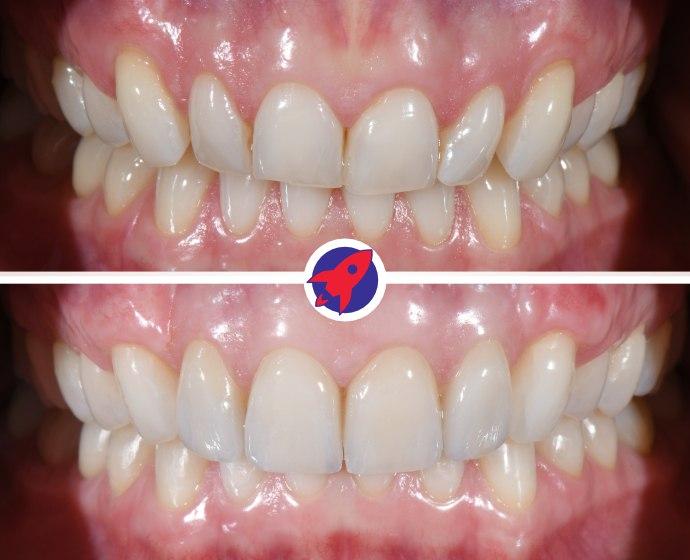 Vorher-nachher Bild eines ästhetischen Falls in dem die schiefen Zähne mit Invisalign begradigt und anschließend mit Veneers verschönert wurden.