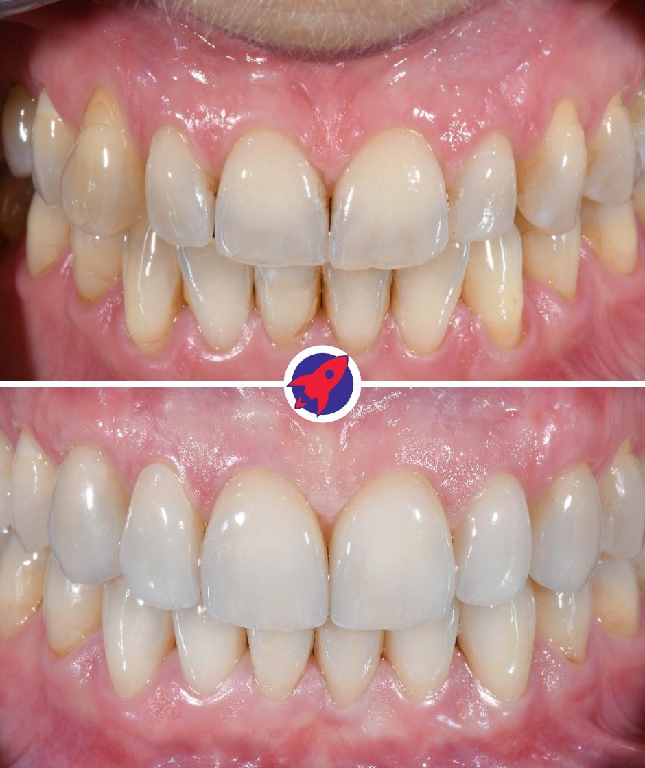 Illustration vorher-nachher einer Invisalign Behandlung zur Begradigung schiefer Zähne.