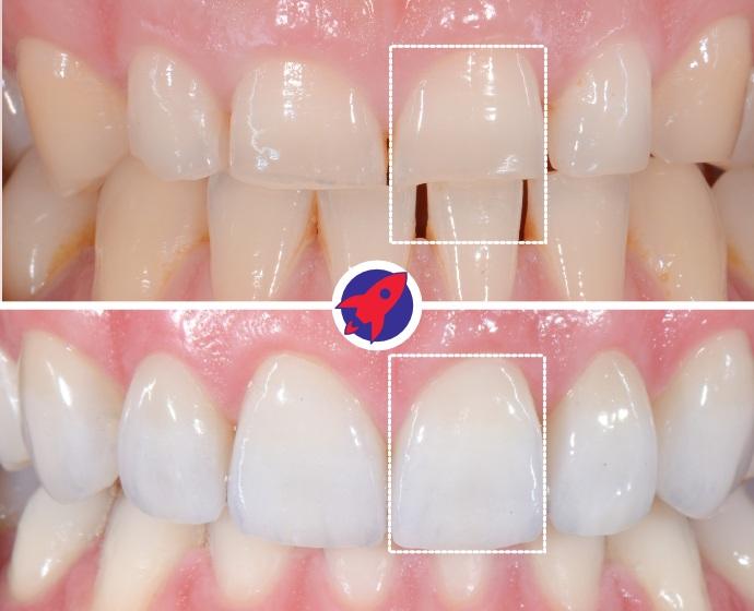 Vorher-nachher Bild einer ästhetischen Behandlung mit Invisalign und Veneers. Dargestellt ist die Wichtigkeit der Zahnproportionen auf das Ergebnis.