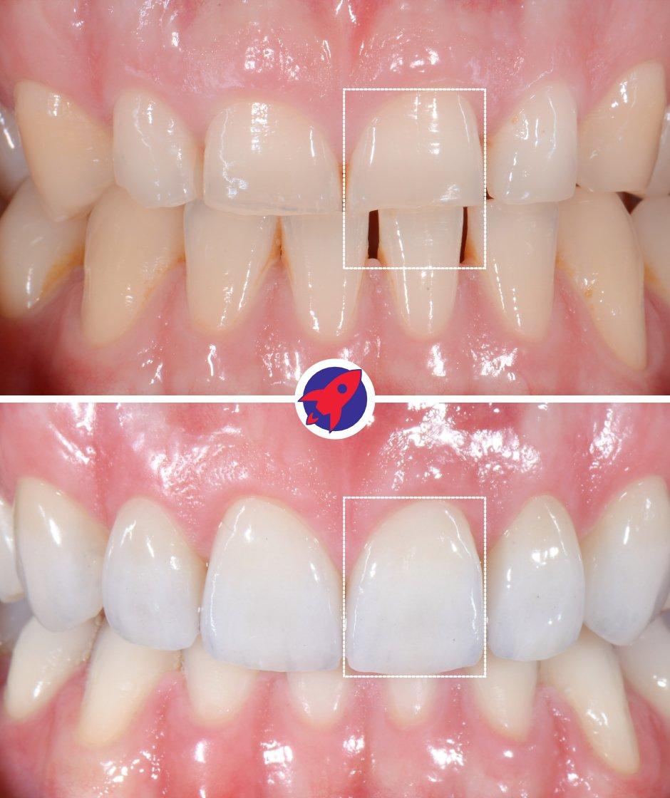 Vorher-nachher Bild einer ästhetischen Behandlung mit Invisalign und Veneers. Dargestellt ist die Wichtigkeit der Zahnproportionen auf das Ergebnis.
