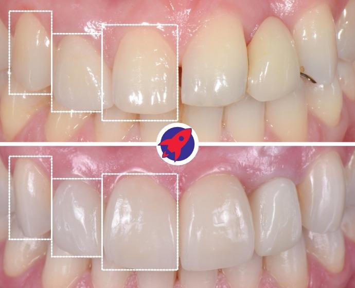 Vorher-nachher Bild einer ästhetischen Behandlung mit Zahnkorrektur, Veneers und operativer Korrektur des Zahnfleischverlaufs. Dargestellt sind die Zahnproportionen im Frontzahnbereich.