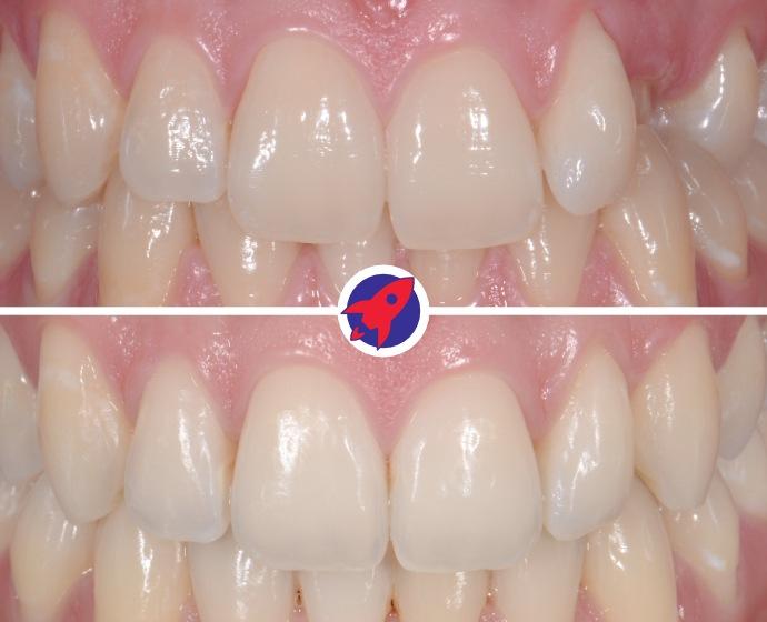 Vorher-nachher Bild einer Behandlung mit einer festen Zahnspange um einen Eckzahn einzustellen.