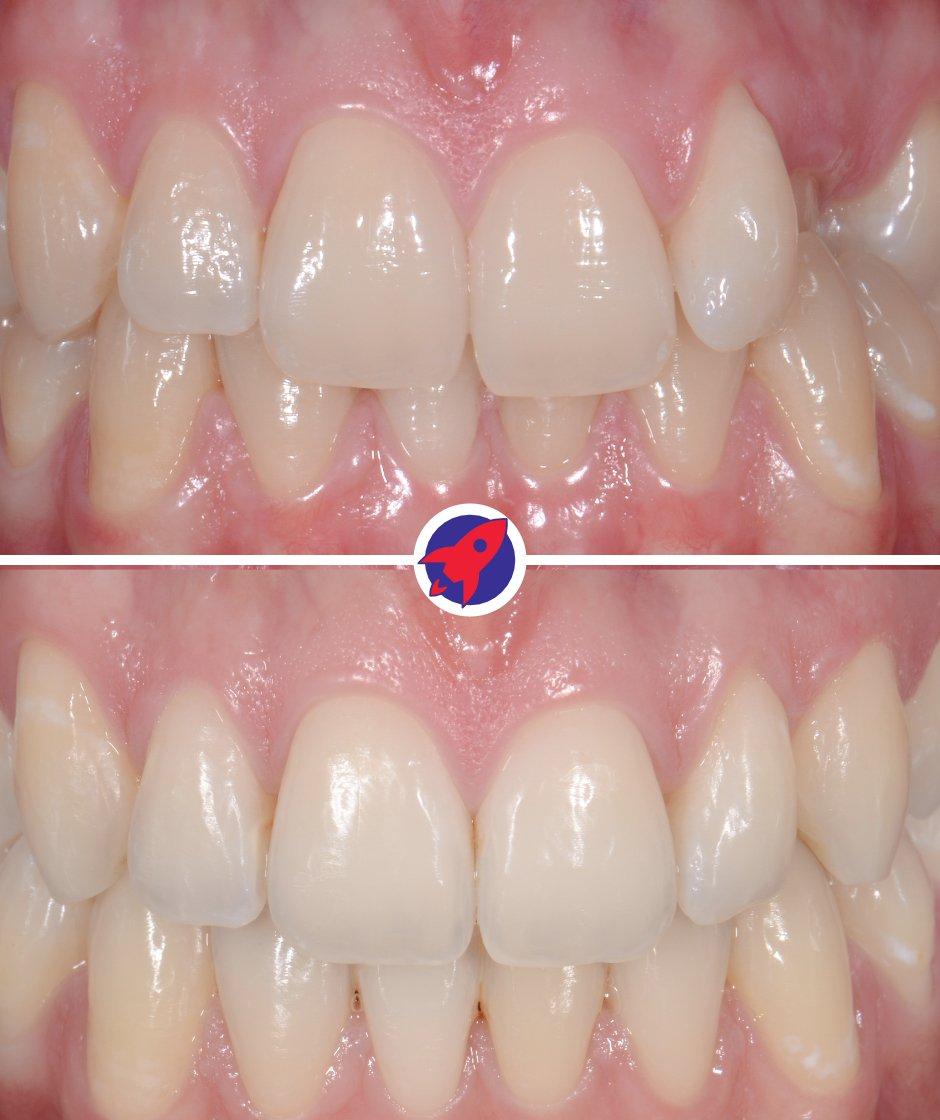 <p>Successful canine correction</p>