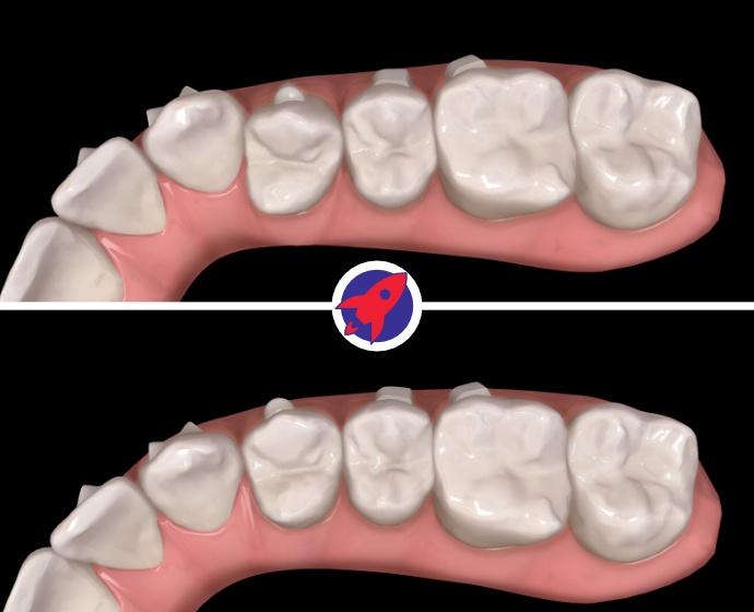 Invisalign Attachments bei Dr. Horvath Wissenswertes & Tipps
