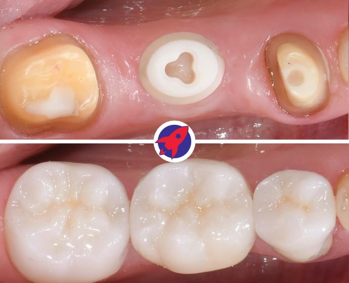 Vorher-nachher Bild eines Keramikimplantats mit dem ein fehlender Zahn ersetzt wurde.