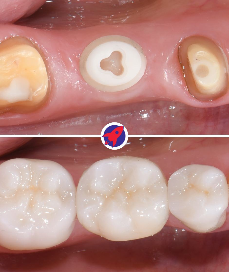 Vorher-nachher Bild eines Keramikimplantats mit dem ein fehlender Zahn ersetzt wurde.