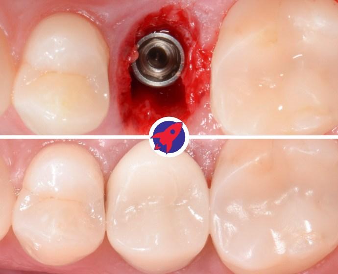 Bild einer Sofortimplantation. Zu sehen ist die Operation in der der Zahn entfernt und das Implantat inseriert wurde. Sowie die fertige Zahnkrone auf dem Zahnimplantat.