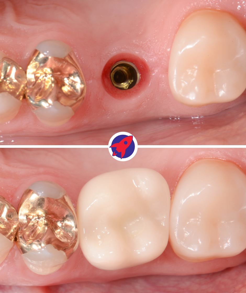 Vorher-nachher Bild einer Zahnimplantats. Zu sehen ist das Implantat im Knochen ohne Krone, sowie die fertige Zahnkrone die den fehlenden Zahn ersetzt.