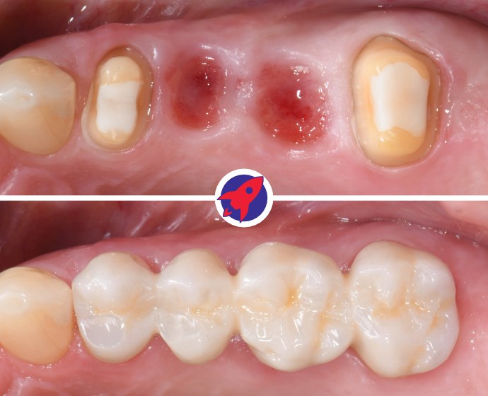 Vorher-nachher Bild einer Zahnbrücke. Mit der festen Zahnbrücke wurden zwei fehlende Zähne ersetzt.