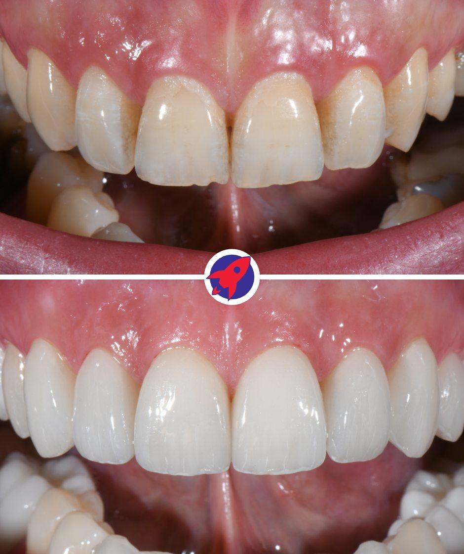 Vorher-nachher Bild einer Behandlung mit 10 Veneers.