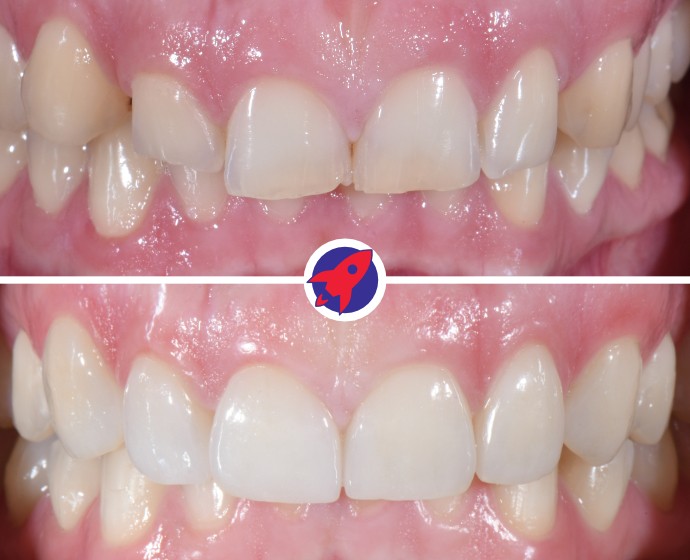 Vorher-nachher Bild einer Behandlung mit Invisalign Alignern und Veneers.
