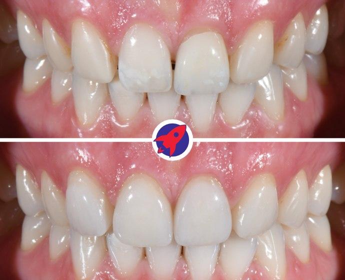 Vorher-nachher Bild einer komplexen Behandlung bei der mesialisierte Eckzähne zu seitlichen Schneidezähnen umgebaut wurden.